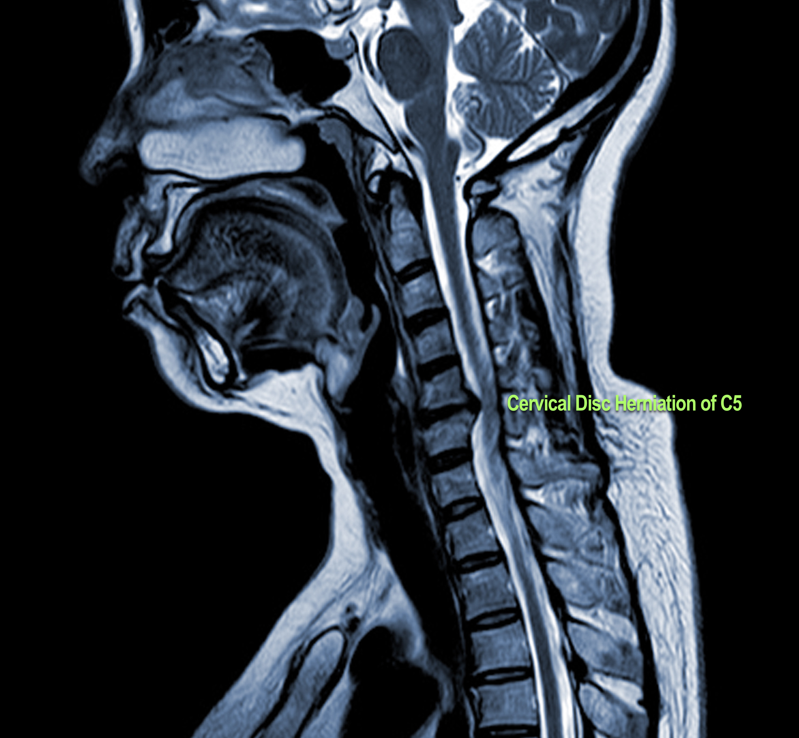 Herniated Disc in the Neck