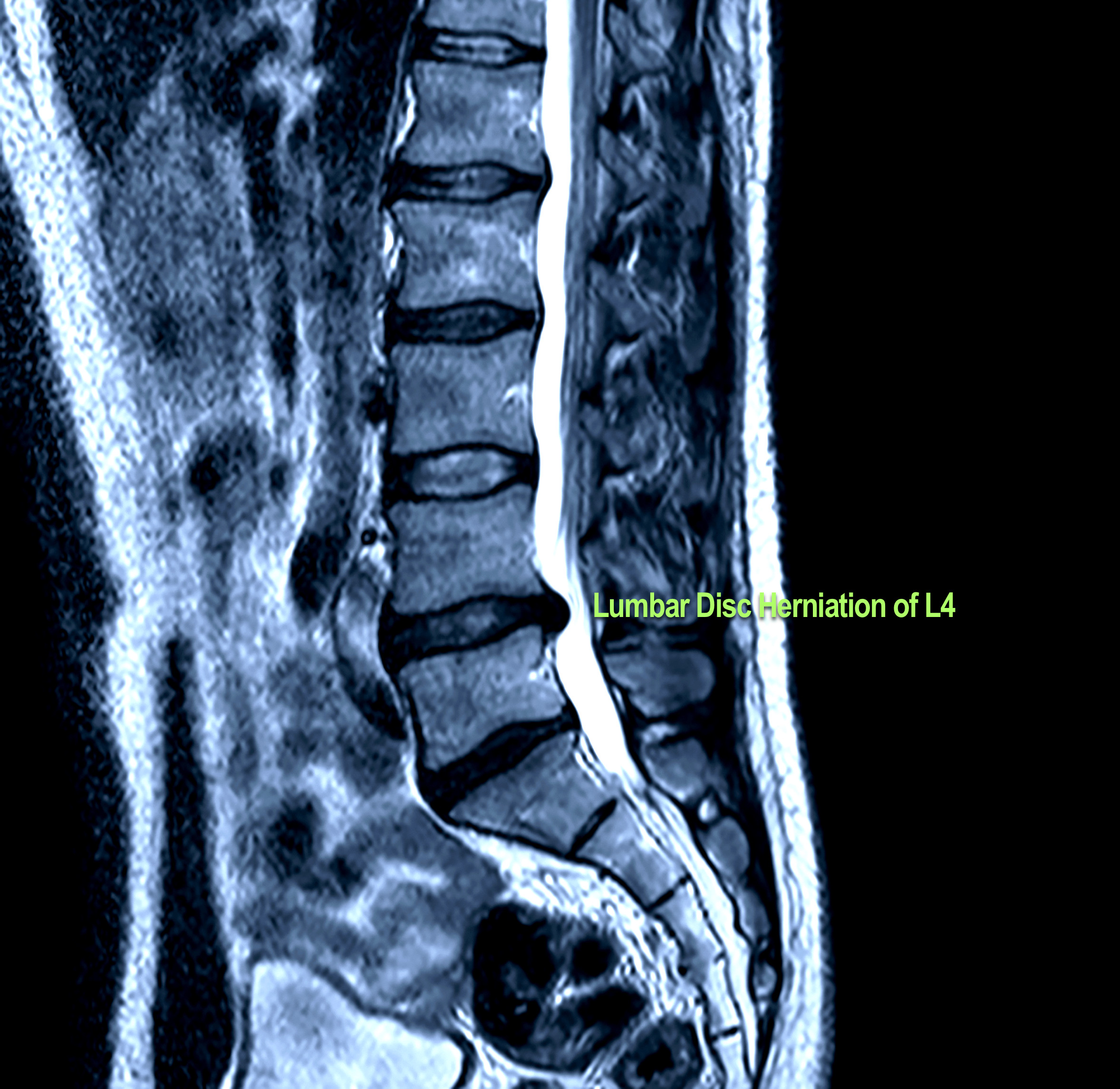 MRI magnetic resonance image - spine with herniated disc that presses on the spinal cord