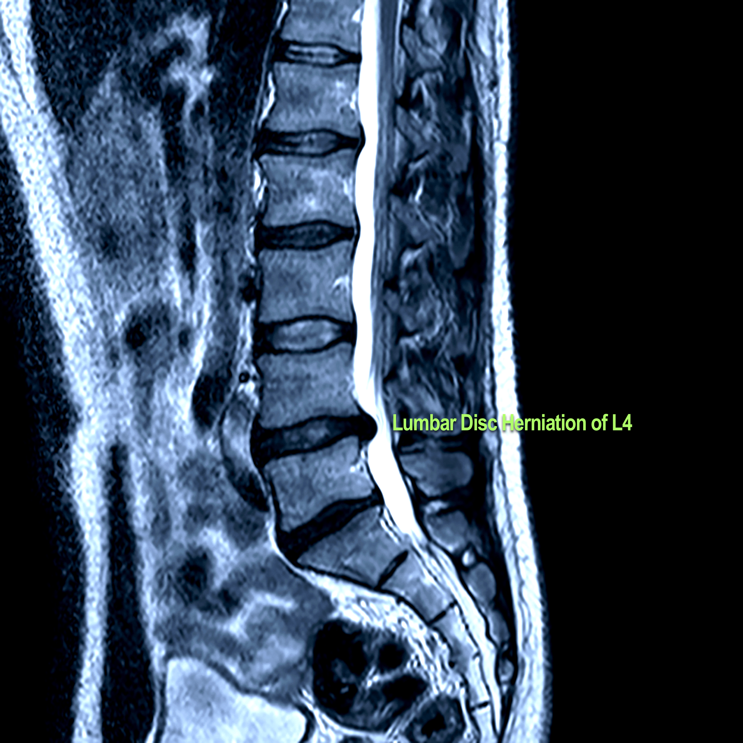 magnetic resonance image - vertebrae of spine with one herniated disc that presses on the spinal cord
