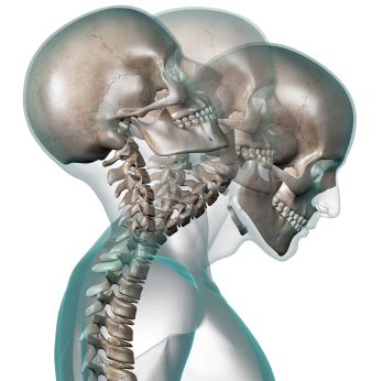 Illustration of whiplash injury