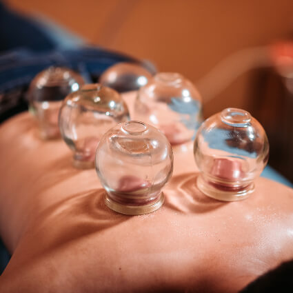 Cupping therapy