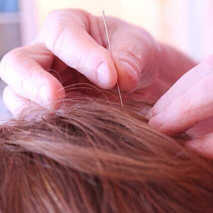 Acupuncture-on-scalp