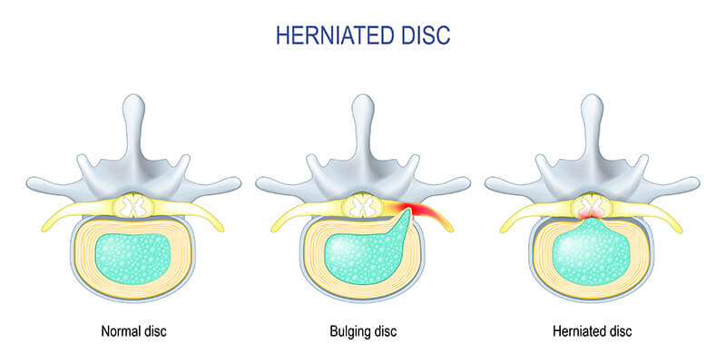 Herniated-Disc-Overlay