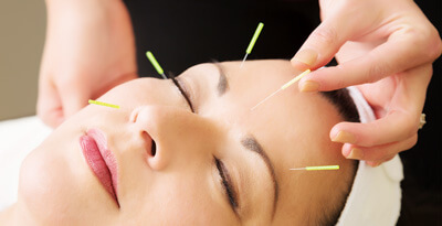 woman getting facial acupuncture