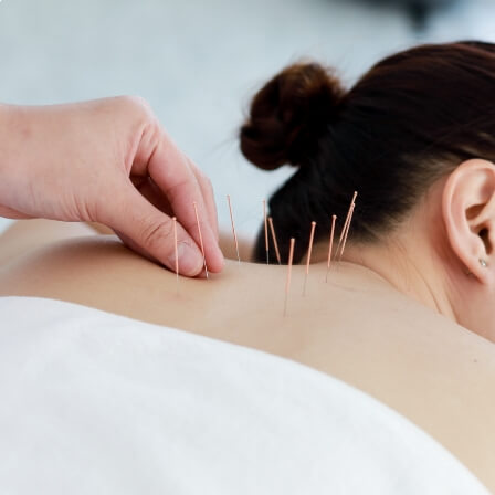 acupuncture needles on back