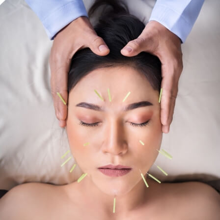 acupuncture needles on face