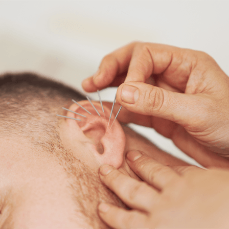 hand with acupuncture needles