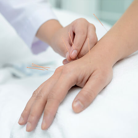 hand with acupuncture needles