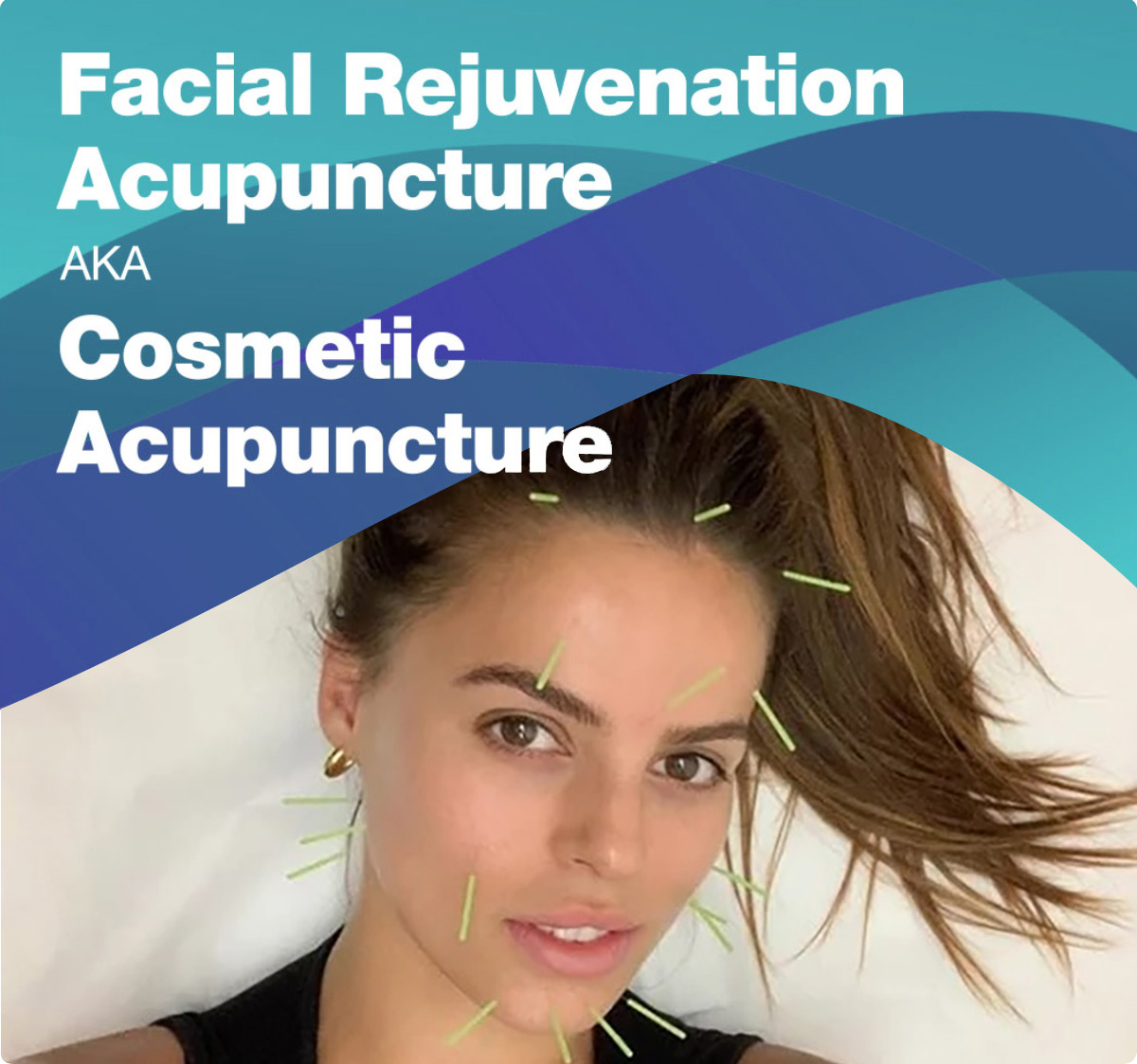 Facial Rejuvenation Acupuncture, a.k.a. Cosmetic Acupuncture