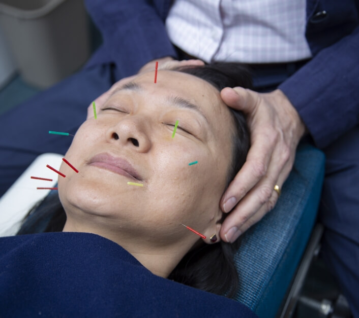acupuncture needles on face