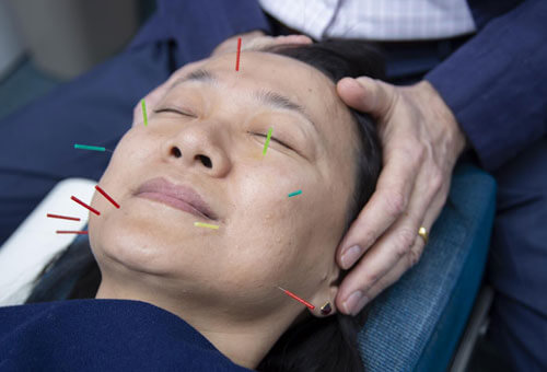 woman receiving acupuncture on face