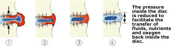 Graphic explaining spinal decompression.