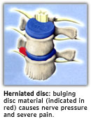 Spinal Decompression