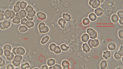 Yeast in Blood Cells through microscope