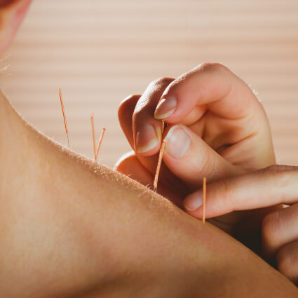 Dry Needling Therapy USED ON BACK