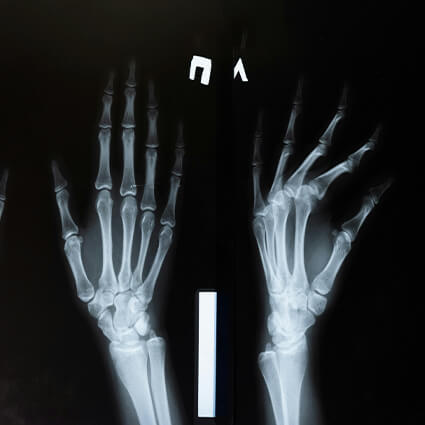 Xray of hands