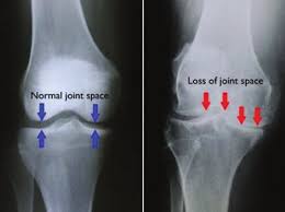 bone on bone knee pain relief in Freehold NJ