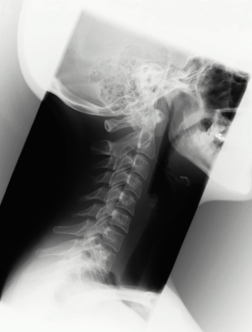 Upper spine x-ray