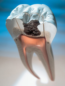 Model displaying the inside of a tooth
