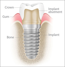 Texas City Dental implants