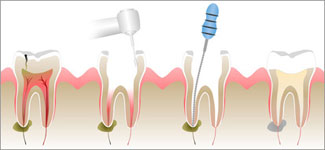 Root canal illustration