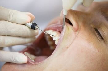 Dentist working on mouth.