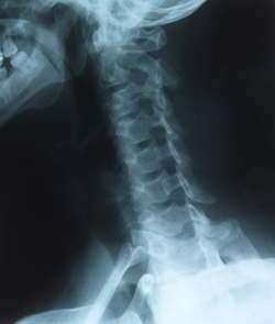 Neck x-ray showing subluxation