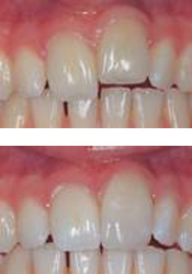 Dental contouring procedure