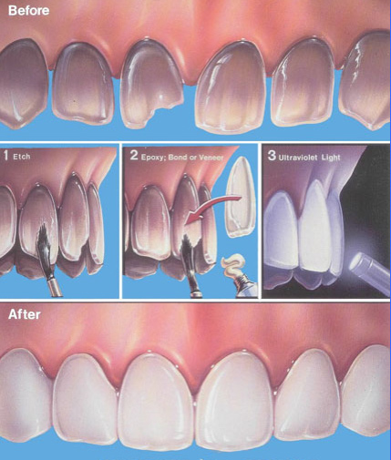 How Are Dental Veneers Fitted?