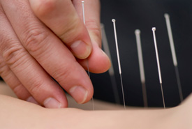 Burlington acupuncture