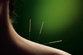 acupuncture needles in shoulder 