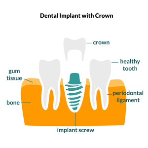 Bridges, Crowns, Implants and Dentures in Byford