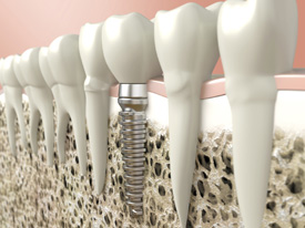 Eastern Long Island dental implants