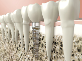 Illustration of dental implant