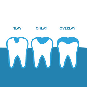 Illustration of dental inlay, onlay and overlay