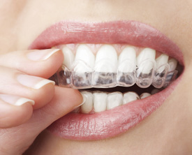 Invisalign is available at First Dental Studio in Brisbane CBD