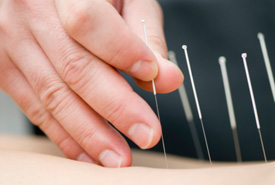 St. Louis acupuncture at Devereux Chiropractic and Acupuncture, LLC