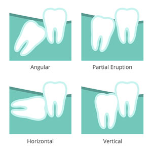 Illustration of different positions of wisdom teeth