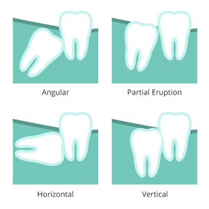 Illustration of wisdom teeth