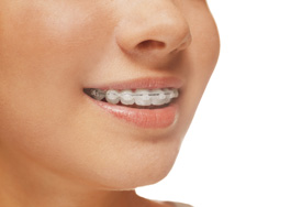 Clear Braces, Ceramic Braces Canberra