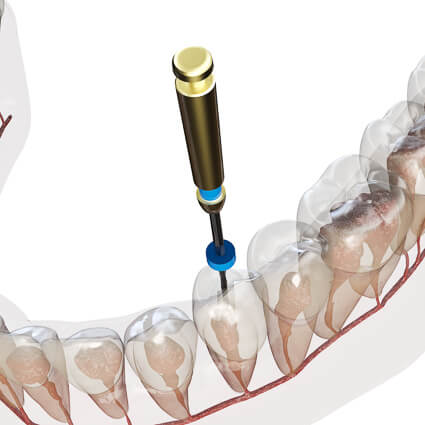 Root canal therapy illustration