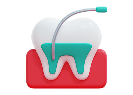 Root Canal Treatment illustration