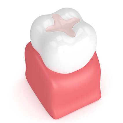 illustration of a dental inlay