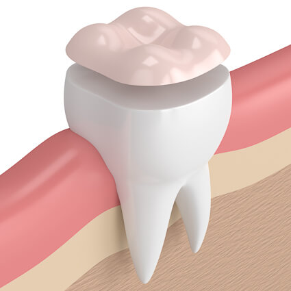 3D illustration of a tooth-coloured restoration on a molar