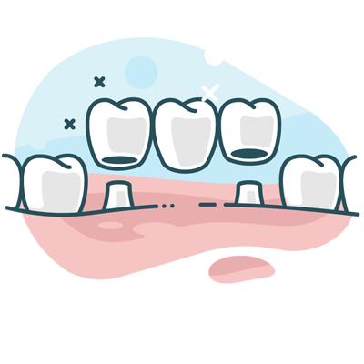 Dental crown and bridge illustration