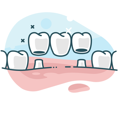 Illustration of dental bridge