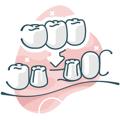 dental bridge illustration