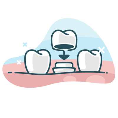 dental crown illustration