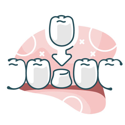 Dental crown illustration