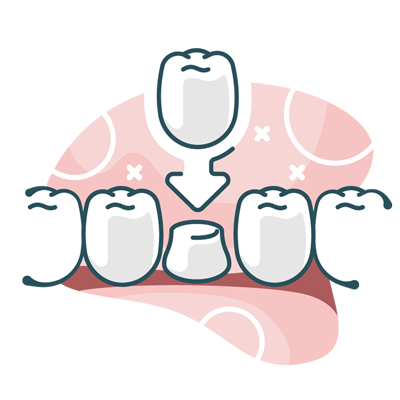 Illustration of dental crown